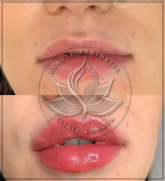 Lip Enhancement & Russian Lips result